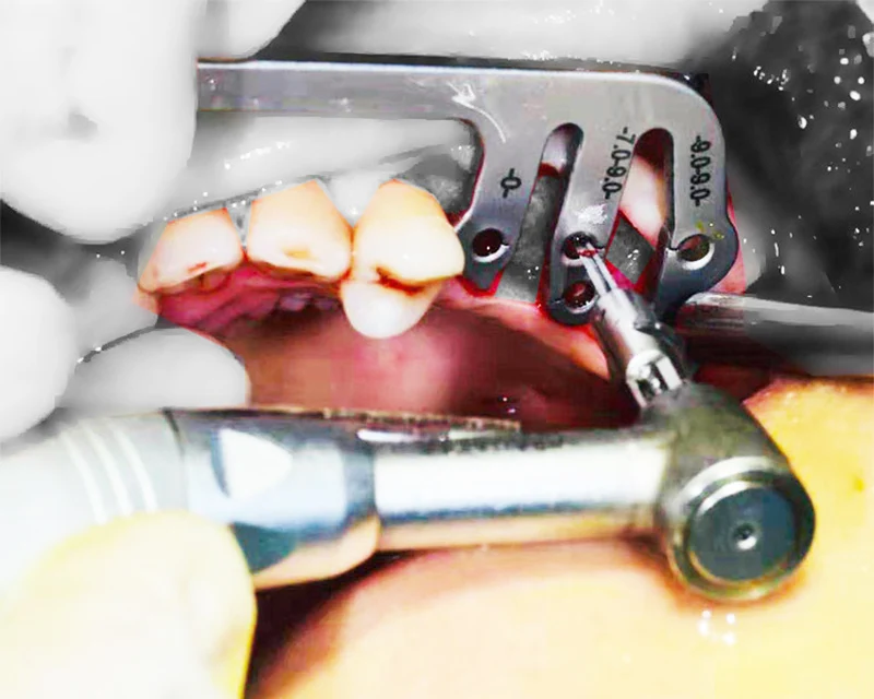 Стоматологический имплантатный хирургический инструмент для оральной посадки