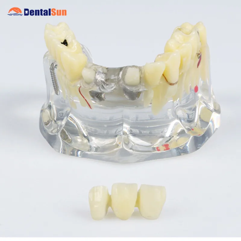 

Dental Orthodontics M2006 Implant Model
