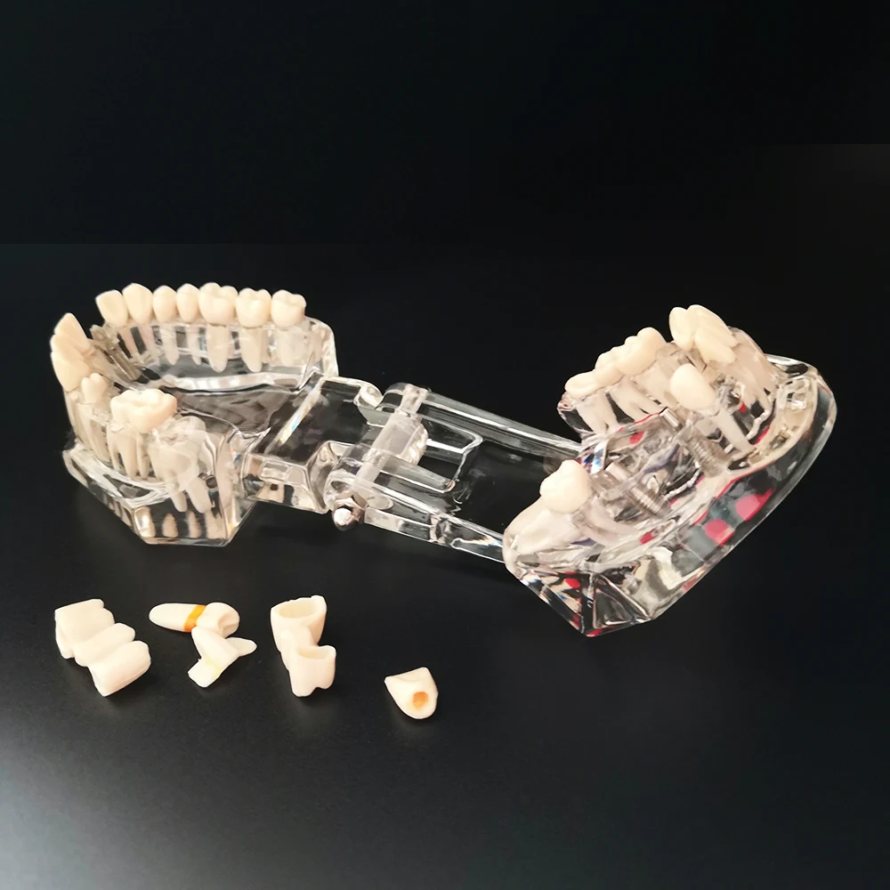 Зубная модель зубной имплантат с реставрационным мостом стоматолог медицинская