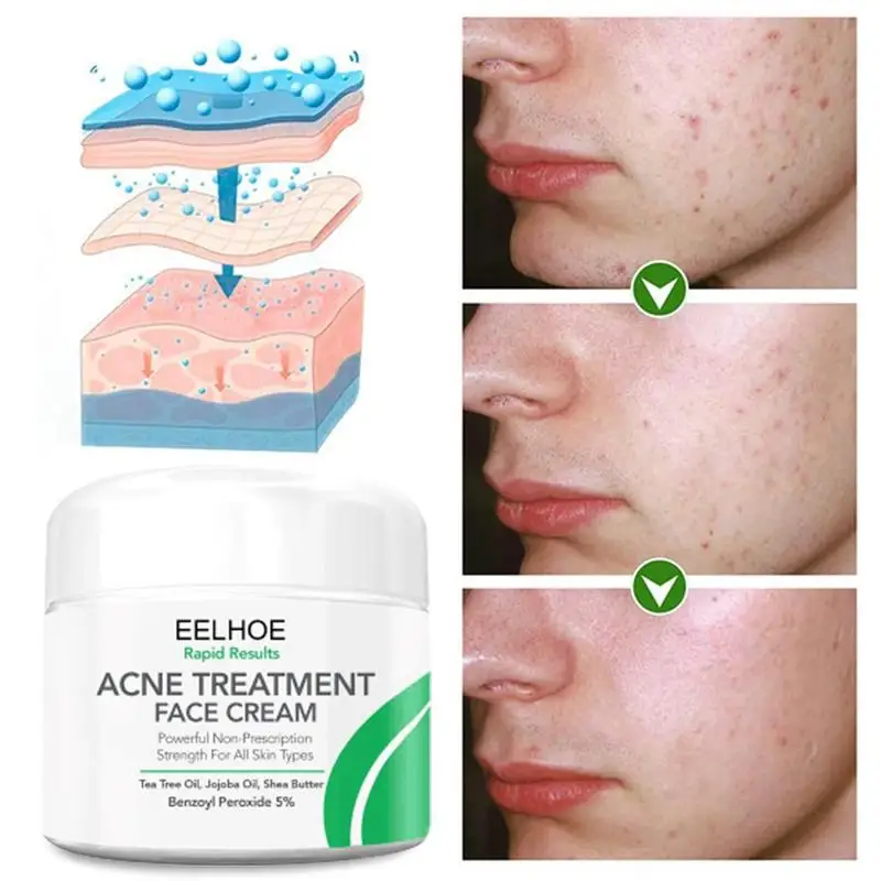 10/30/50g Herbal Acne Cream Anti Pimple Spot Acne Scars Blackhead Removal Cream Whitening Beauty Skin Face Care Creams