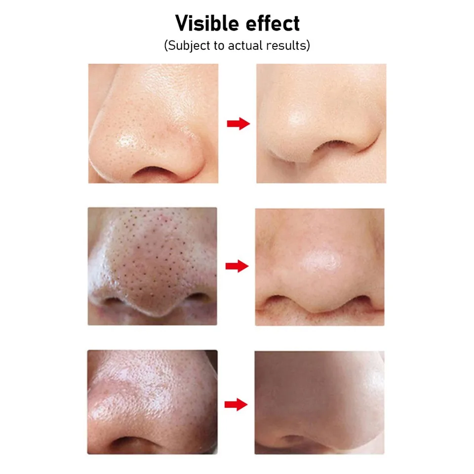 Электрический прибор для удаления черных точек с черными точками лица и пор