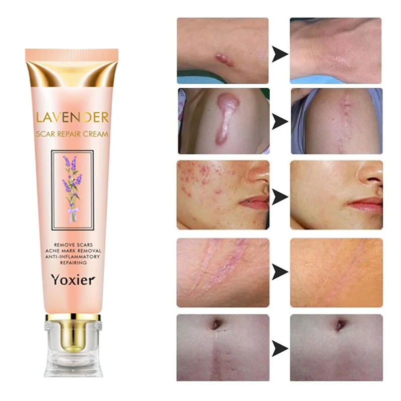 Крем для восстановления шрамов лаванды восстанавливающий шрамы от ожогов