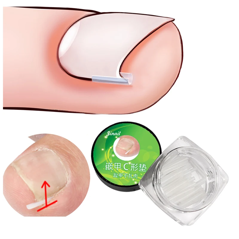 10 шт. вросших ногтей Pad Ортодонтическая страховочная полоса наполнения Groove