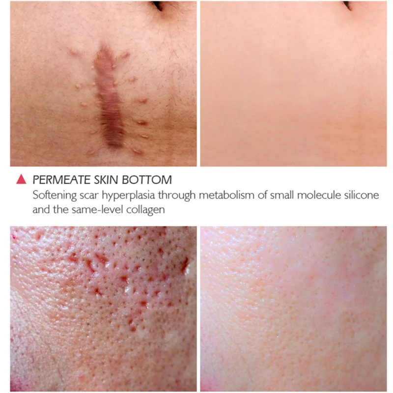 Crocodile Scar Repair Face Serum Acne Scar Removal Whitening Dark Spots Stretch Marks Treatment Skin Care