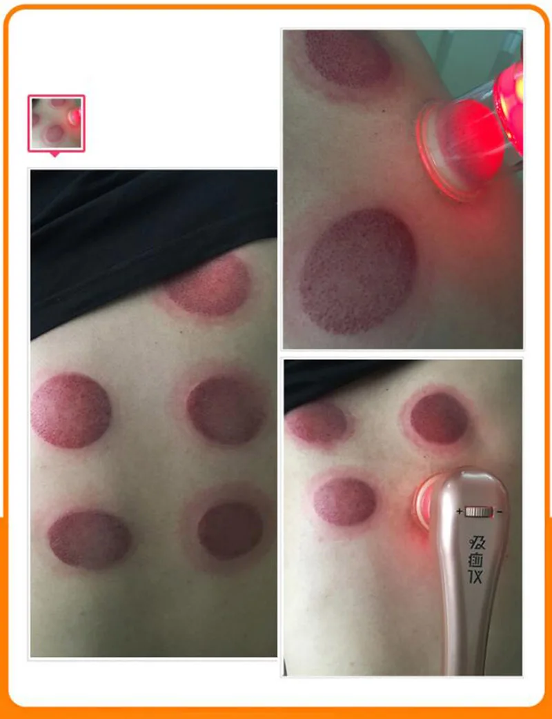 Электрическая сеточная щетка sha поглощающий инструмент для купирования терапия