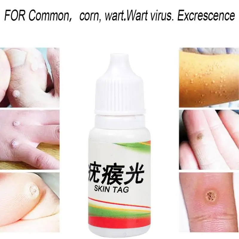 10 мл кожу средство удаления бирок моль женских половых органов для бородавок