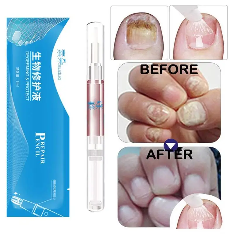 Средство для лечения грибка для ногтей продукты Onychomycosis Paronychia противогрибковые инфекция ногтей китайская травяная масляная ручка для здоровья