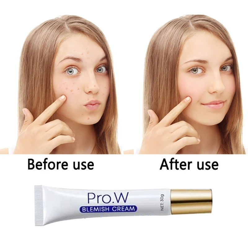 2021New 30g Face Blemish Freckle Cream Pimple Acne Treatment Scar Dark Spots Removal Whitening Moisturizing Skin Repair Ointment