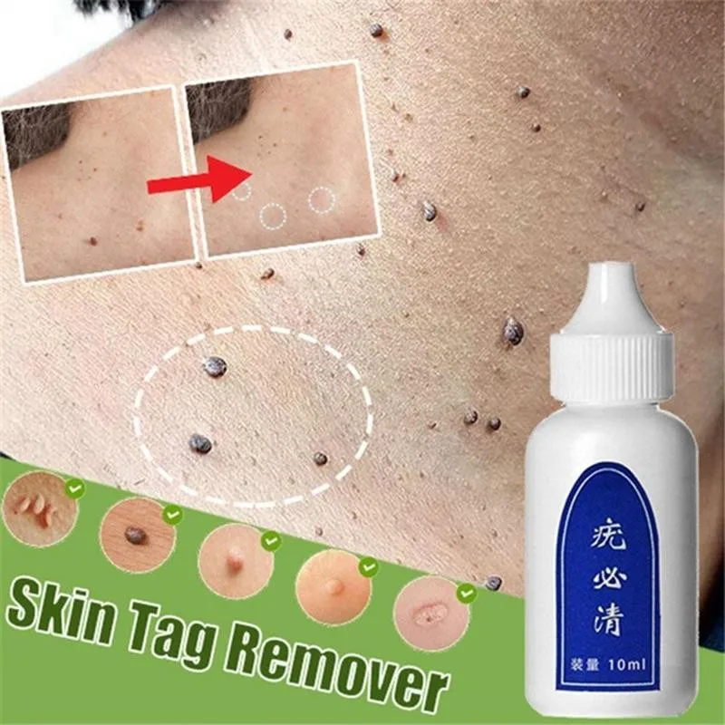 

10ml Skin Tag Remover Chinese Medicine Body Warts Treatment Foot Corn Removal 12 Hours Remover Skin Tag Remover Foot Care