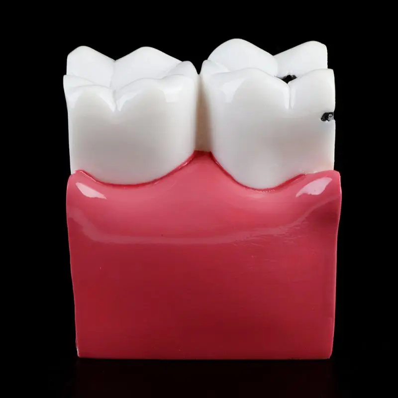 

6 Times Dental Caries Comparation Anatomy Teeth Model for Dental Anatomy Lab Teaching Studying Researching Tool