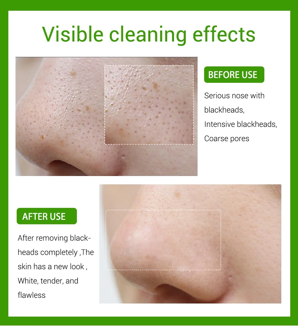 LANBENA 15 мл средство для угрей в носу удаления черных точек жидкое на лечение акне