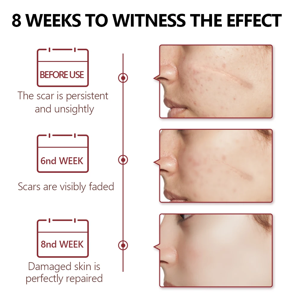 Восстанавливающая Сыворотка для крокодиловых шрамов лечение акне растяжки