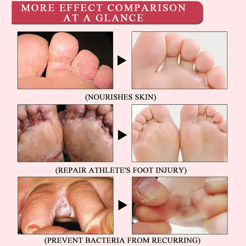 Травяное лечение ног против грибковой инфекции онихомикоз паронихия