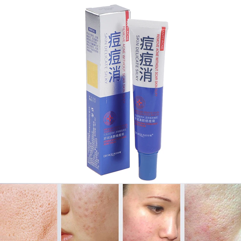 1pcs Anti Acne Cream Oil Control Shrink Pores Nourish Skin Acne Scar Remove Face Cream 30g