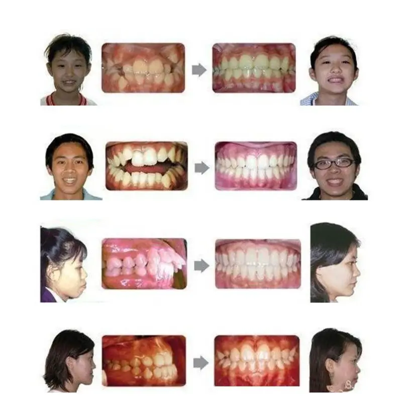 Зуб зубные ортодонтический бытовой Тренер Профессиональный выравнивание
