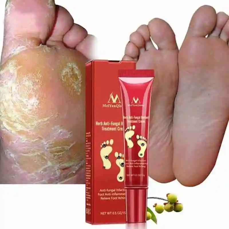 

Anti-Fungal Infection Foot Anti-Inflammatory Relieve Treatment Cream Beri Herb Foot Itching F7P4