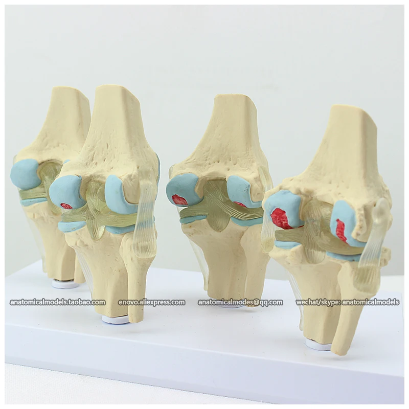

12359 / Human 4-Stage Osteoarthritis Knee Set Joint Study Model, Medical Science Educational Anatomical Models