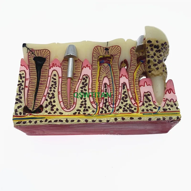 Стоматологическая модель зубов кариеса обычная патологий обучающая для