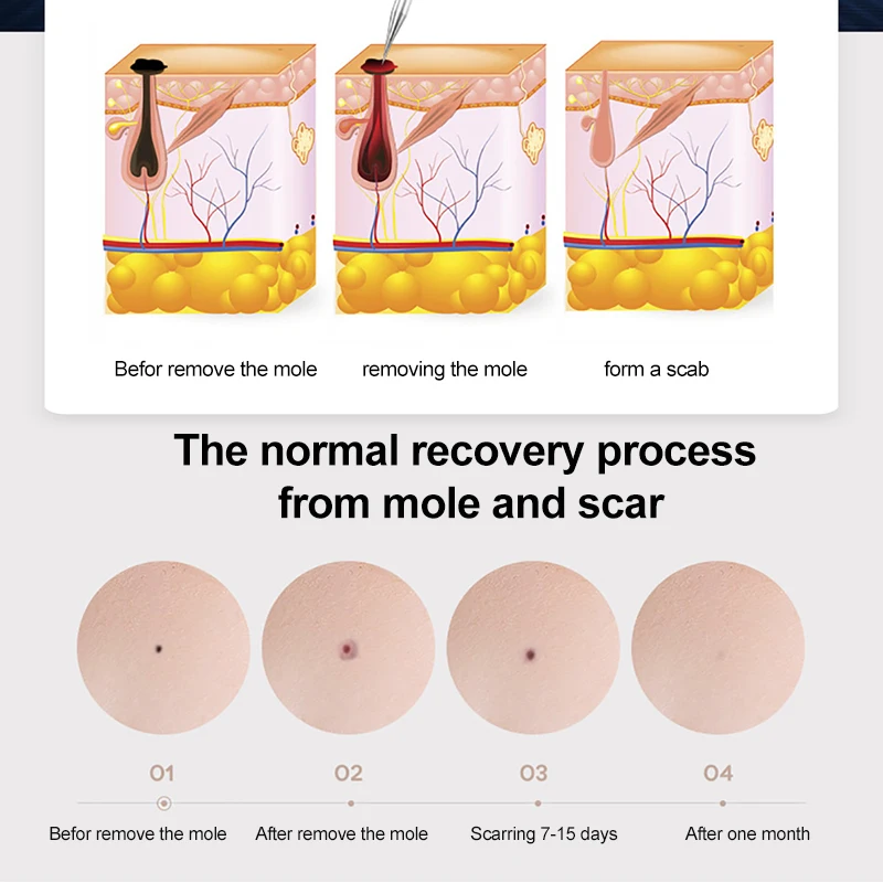 

Laser Plasma Pen Mole Tattoo Removal Pen 9 Level LED Face Skin Dark Spot Remover Freckle Tag Wart Removal Tool Beauty Machine