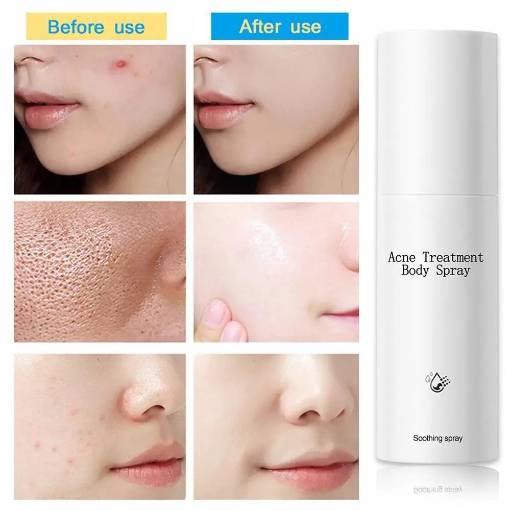 100ml New Acne Treatment Spray Moisturizing Spray Skin Essence Face Spray Acne Oil Treatment Oil-control Q6g8