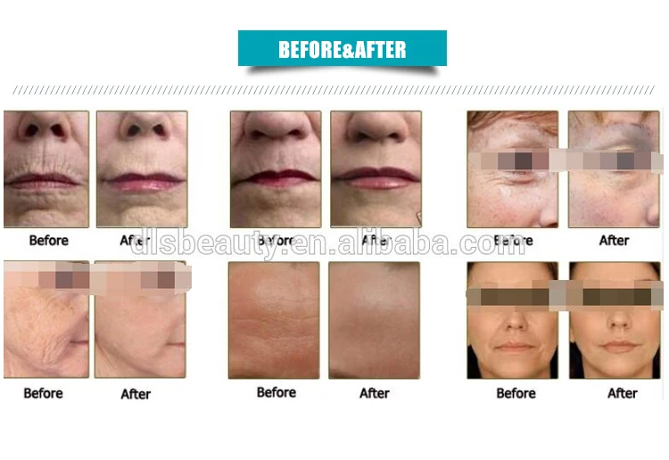 Профессиональный 2 в 1 для лица hifu+ liposonix для похудения и удаления морщин против возраста