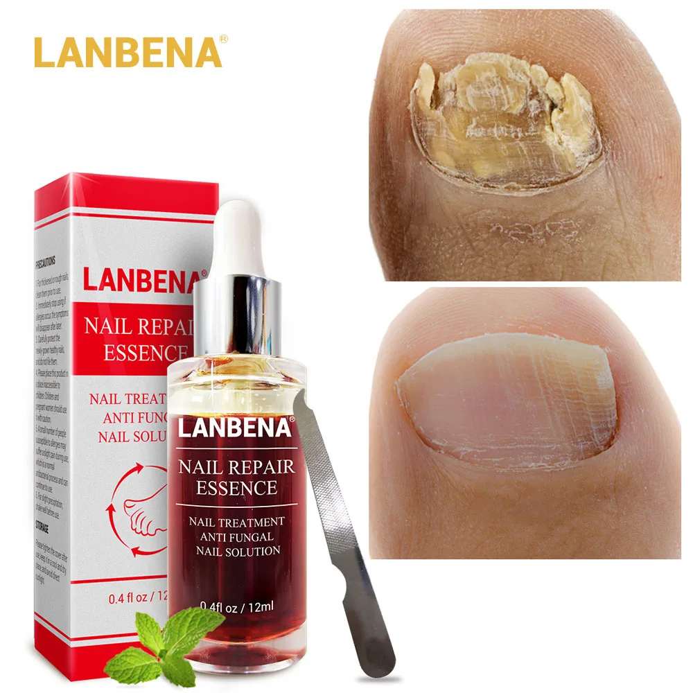 

Fungal Nail Treatment Essence Nail and Foot Whitening Toe Nail Fungus Removal Whitening Onychomyco Feet Care Nail Gel Tools