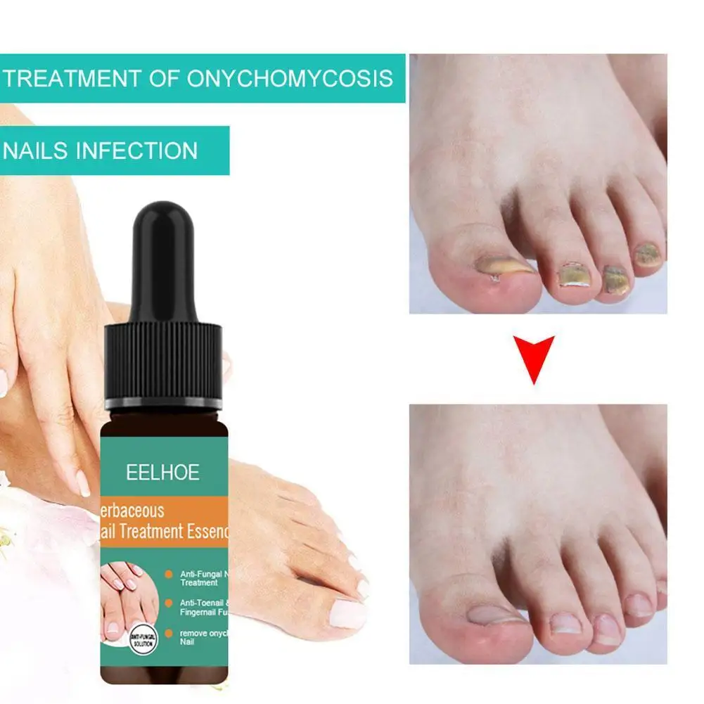 

10/30Ml Onychomycosis Liquid Hand And Foot Onychomycosis Thickening Care And Nail Treatments Repair Antibacterial W7E4