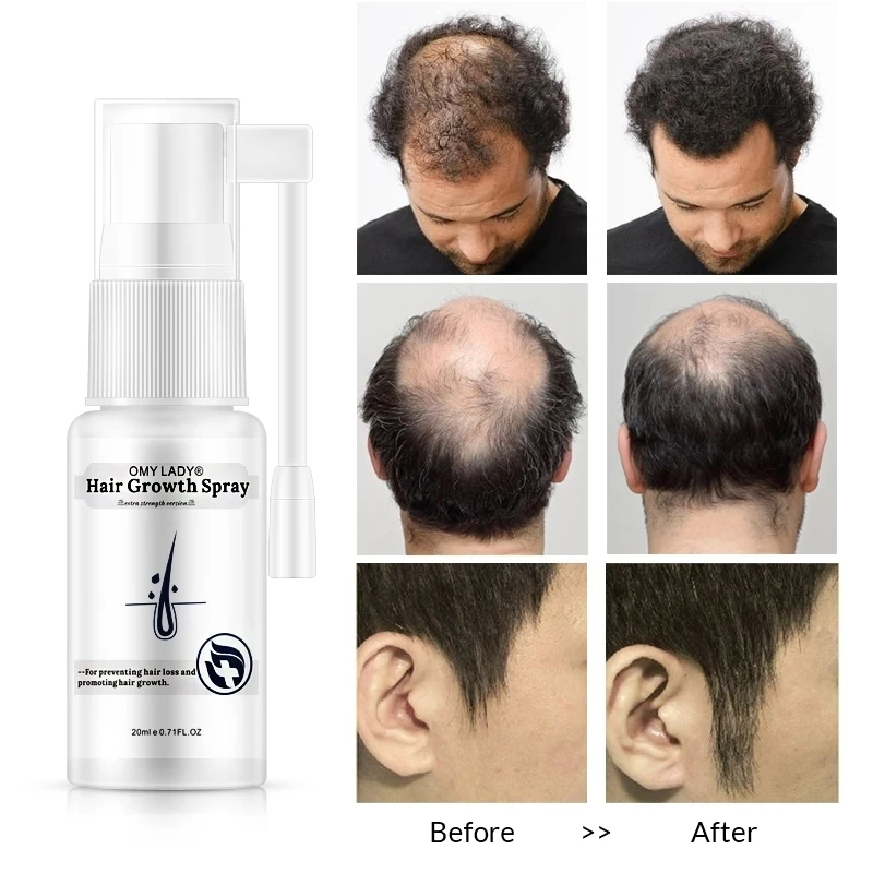 

Anti Hair Loss Hair Growth Spray Essential Oil Liquid For Men Women Dry Regeneration Repair Hair Loss Products Tool Styling