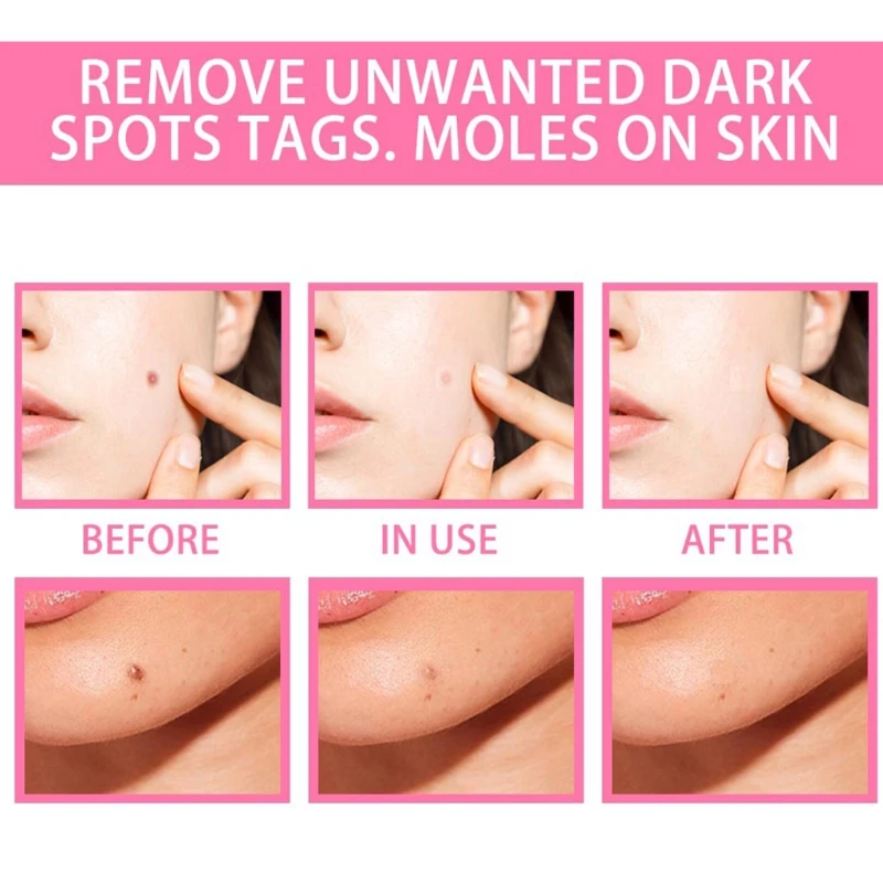 

20ml Organic Skin Tag Solution Serum Painless Labels Mole Removal Freckle Oil