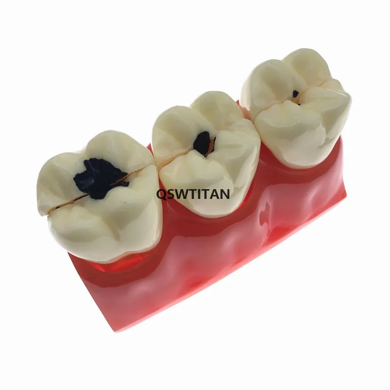 В 4 раза кариеса Comparation модели зубов Модель обучения научно исследовательских