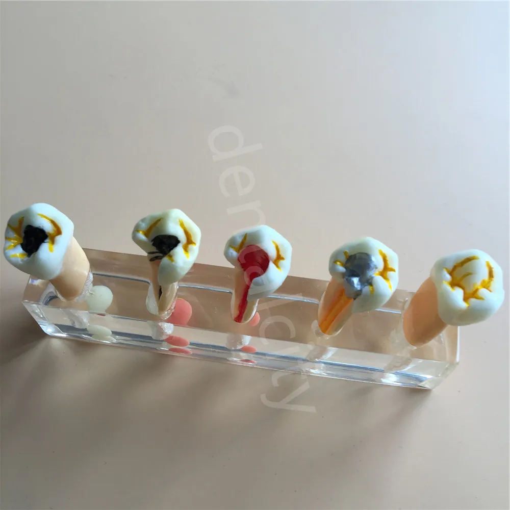 Стоматологическая 5 ступенчатая модель для лечения зубов обучения Лидер