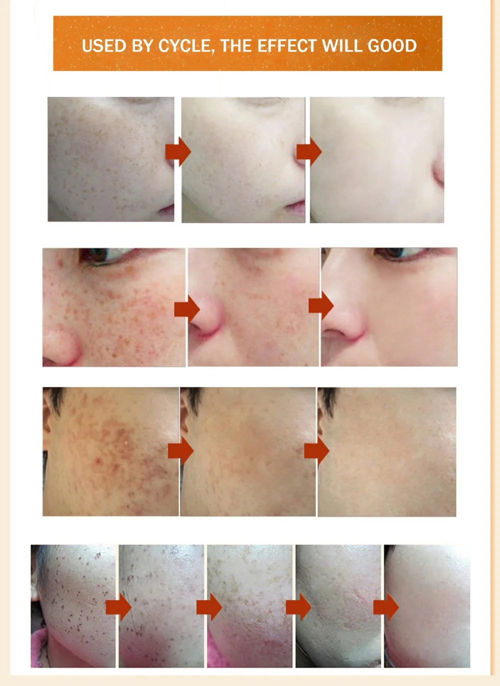 Отбеливающий крем Crema Blanqueadora Melasma для пигментации, удаления веснушек, удаления темных пятен для ухода за кожей лица, осветление