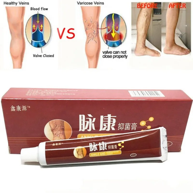 Varicose Vein Ointment Dredge Blood Vessels Spider Veins Vasculitis Treatment Product | Красота и здоровье