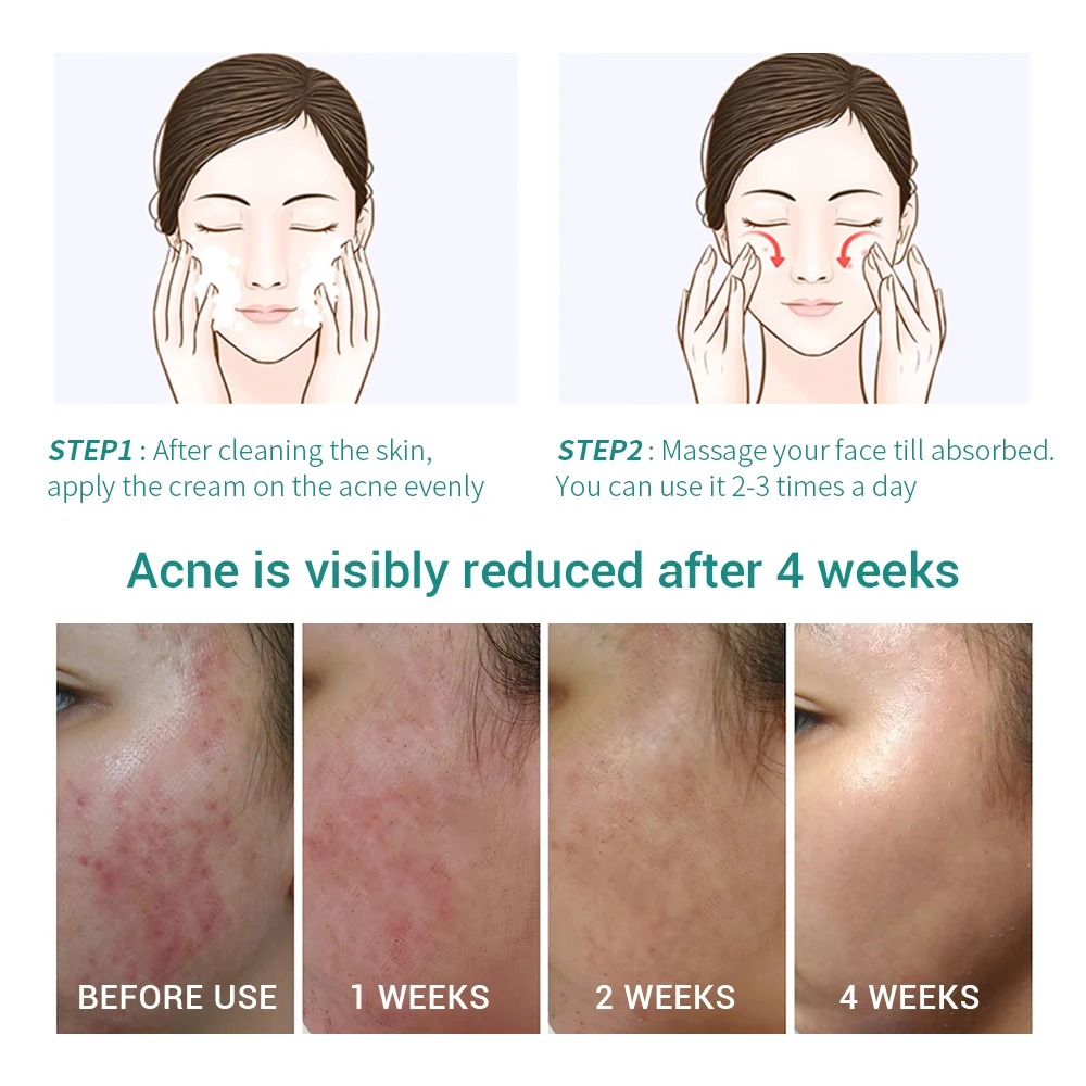 

Aloe Acne Treatment Gel Face Cream Serum Anti Acne Scar Cream Shrink Pores Moisturizing Oil Control Soothing Essence Skin Care