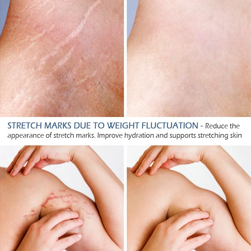 Crocodile Stretch Marks Remover Cream Anti Aging Winkles Firming Body Care Pregnancy Scars Ance Maternity Repair Dropshipping |