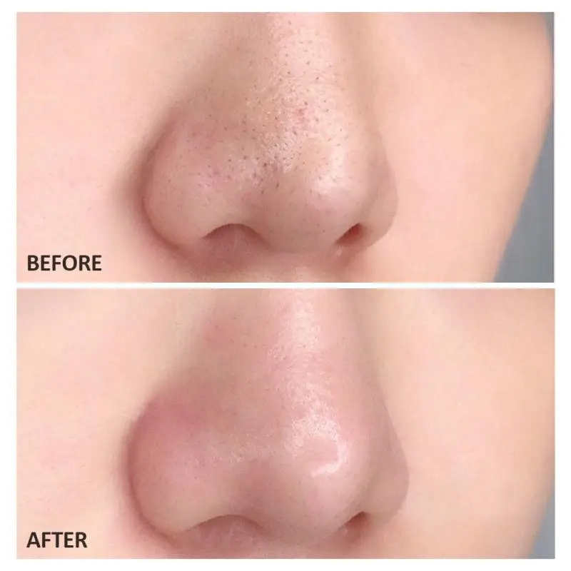 10/20 шт. удаление угрей маска назальная мембрана минеральной грязью носовые патч