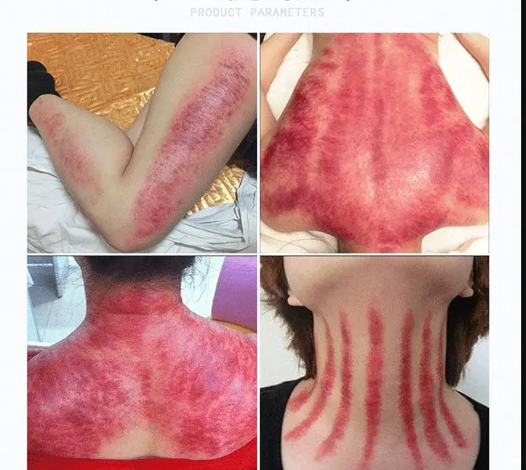 Меридиан скраппинг инструмент баночный аппарат электрическое давление