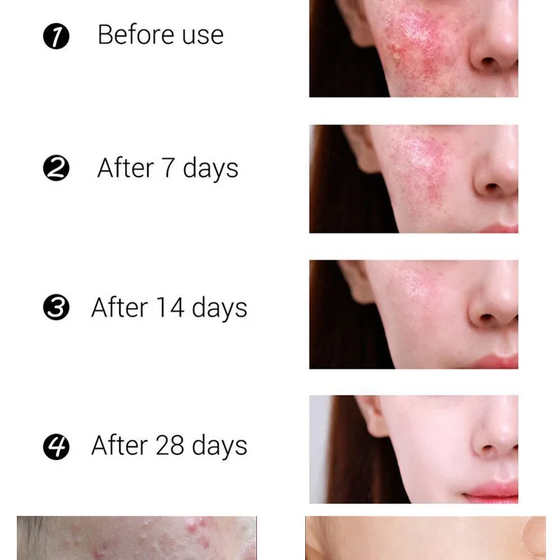 30 г крем от акне лечение угрей сокращение пор ремонт удаления контроль шрамов