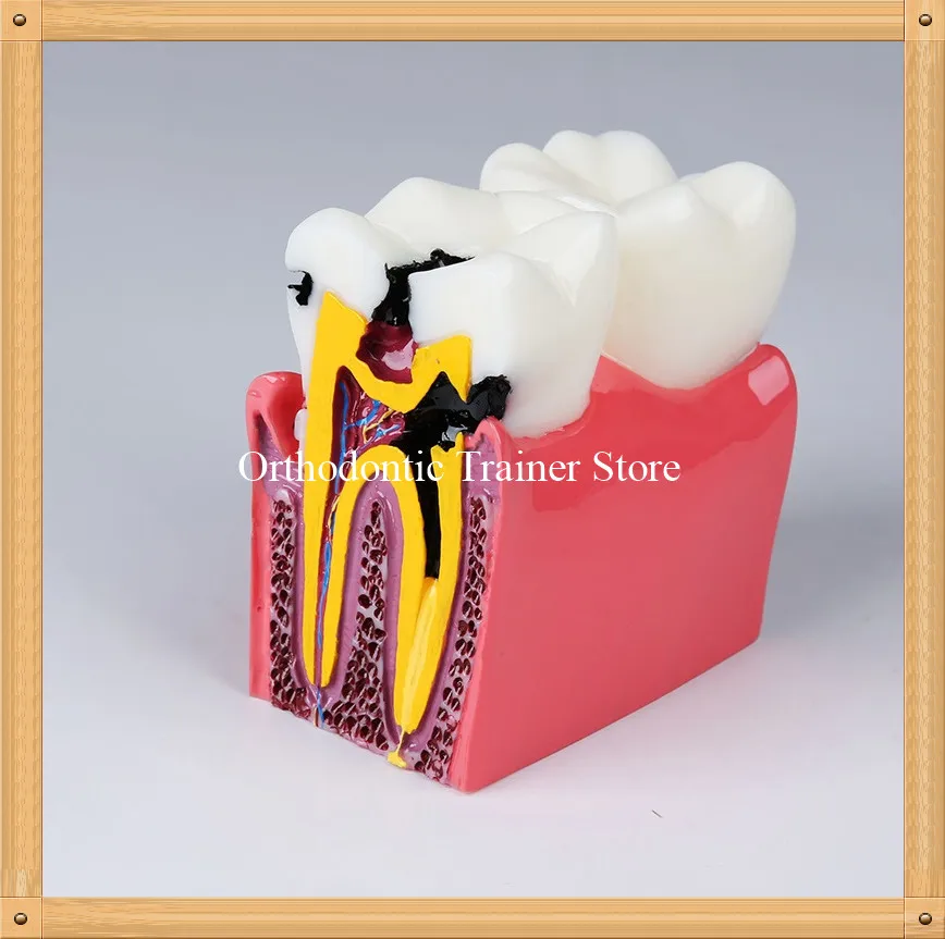 6 раз Стоматологическая модель зуба корневого канала/модель зубов