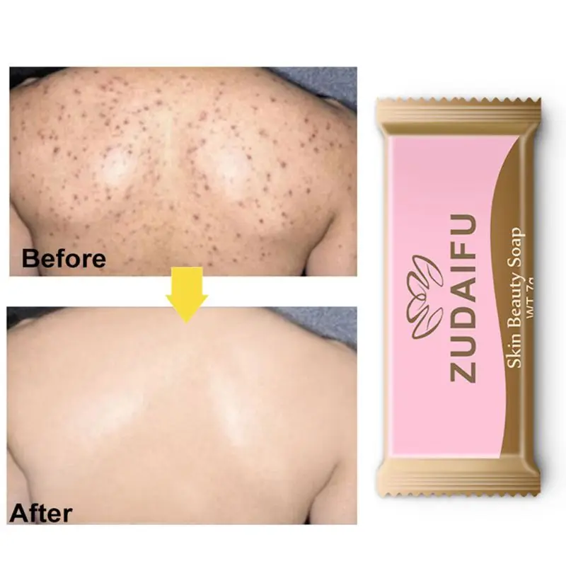 

5Pcs Portable Sulfur Soap Anti-mite Oilcontrol Acne Treatment Blackhead Remover GXMC