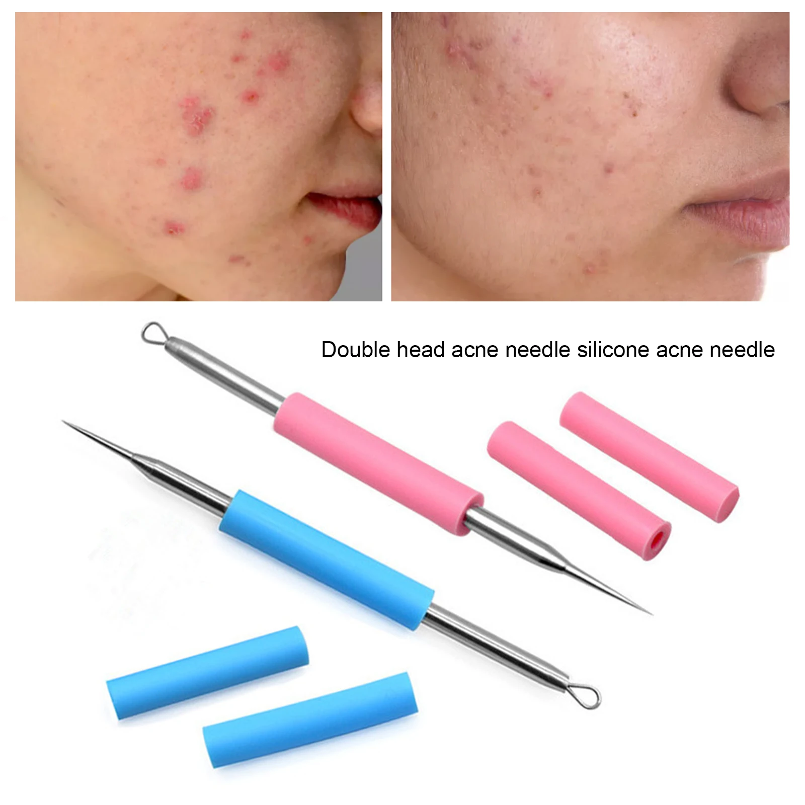 

1PC Facial Acne Remover Needle Facial Acne Pimple Extractor Blackhead Remover Tool Pimple Remover Stainless Steel
