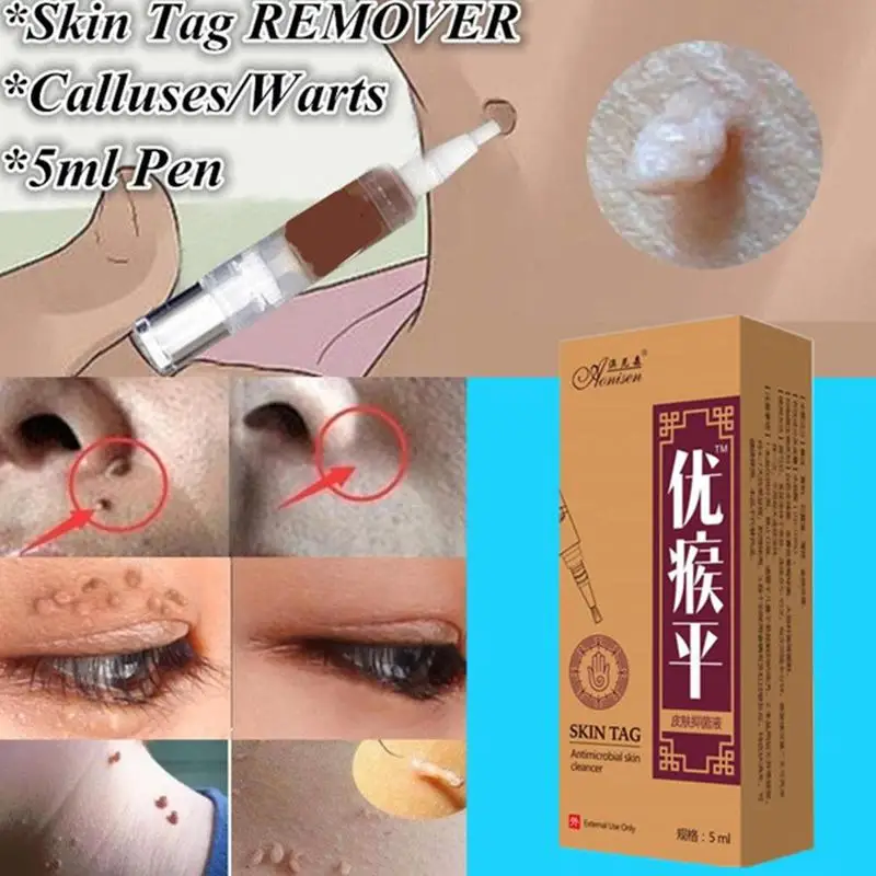 

Skin Tag Remover Pen 12 Hours Tu Kill Remover Medical Skin Tag Mole Genital Wart Remover Foot Corn Verruca Wart Remover Liquid