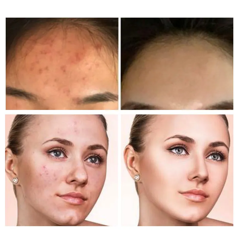 

Solution 30ml Ordinary AHA 30% + BHA 2% to peel that dead top layer Anti Skin Care Serum Oil Balance Base