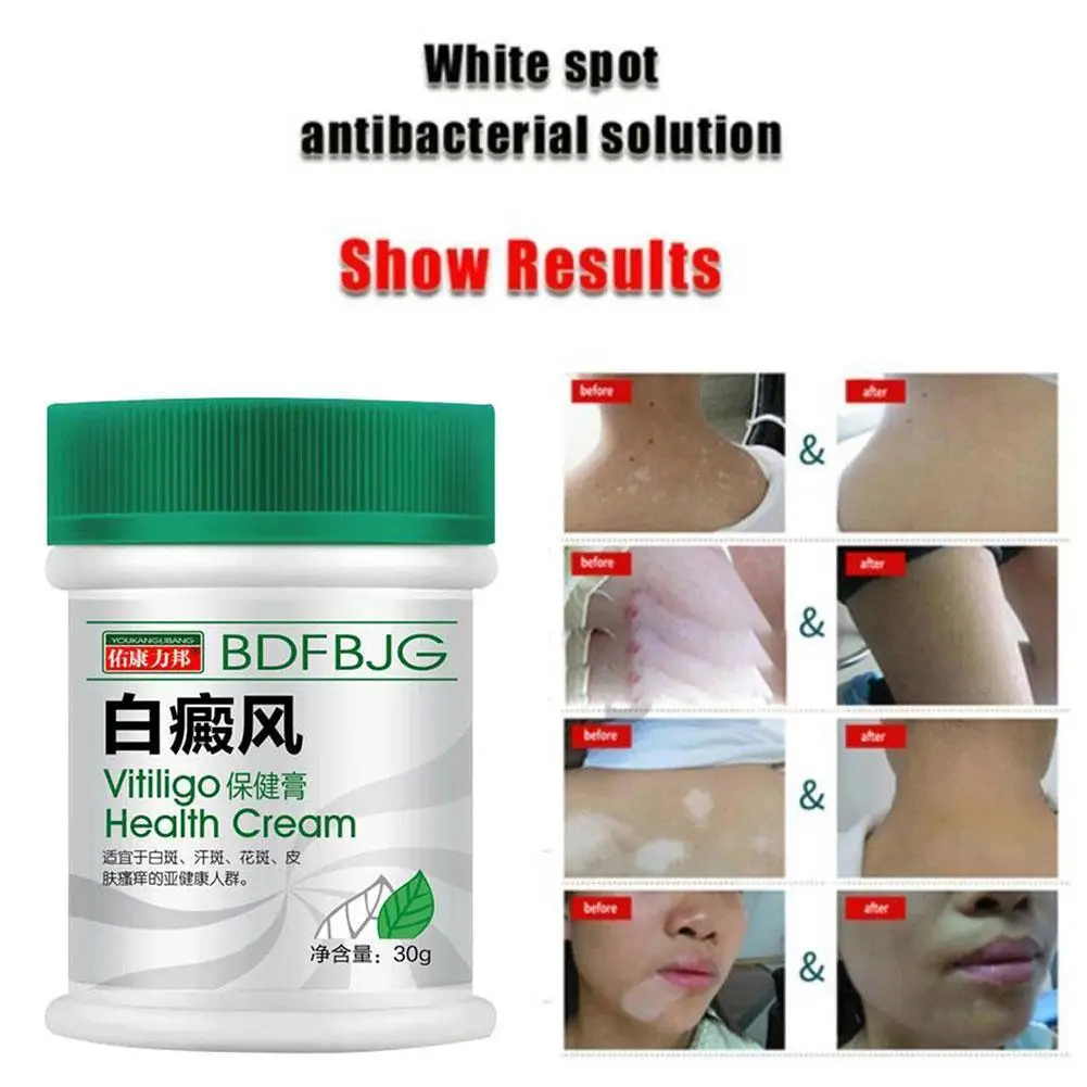 

White Spot Disease Treatment Ointment Leukoplakia Disease Repair Vitiligo Pigment Cream Skin Melanin Chinese Medical Balm C O5A5