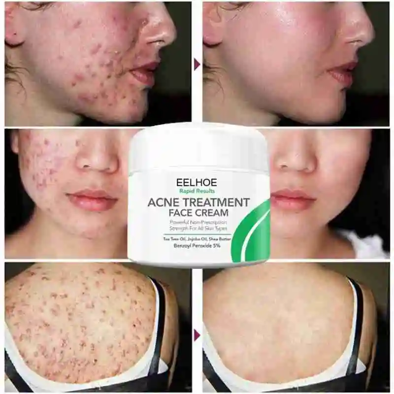 Botanical Anti-Acne Face Cream, Oil Control, Pore Shrinking and Acne Cream, Anti-Acne Whitening, Acne Scar Removal, Skin Cream