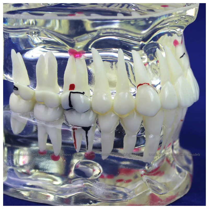 

12568 / Transparent Adult Dental Study Disease Tooth Model, Medical Science Educational Dental Teaching Models