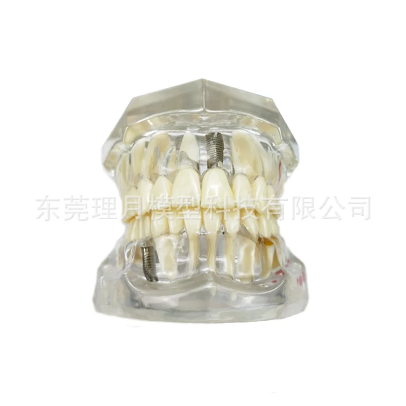 Смоляная съемная модель зубов стоматологическая передвижная патологическая