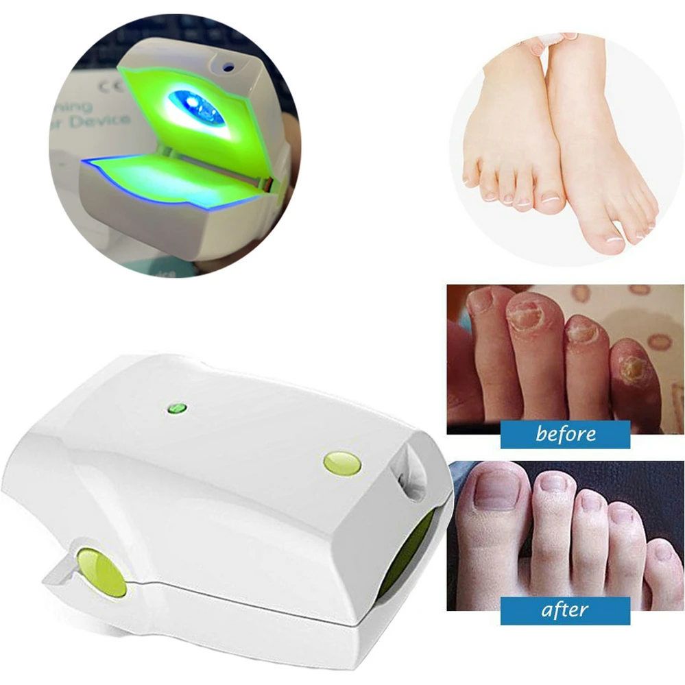 Portable 905nm Low LLLT Toenails Laser Therapy Device for Nail Fungus Onychomycosis Anti Fungal Laser Device