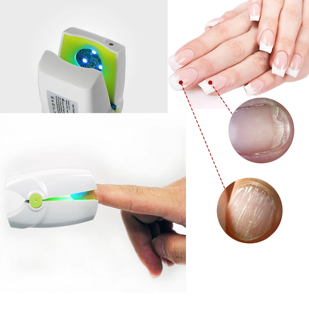 

Fungal Nail Renewal Clean Fungus Onychomycosis Home Use Anti Toenail Fingernail Ringworm Infection Cold Laser Light Therapy