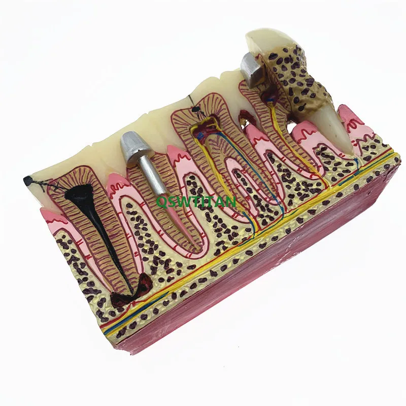 Стоматологическая модель зубов кариеса обычная патологий обучающая для